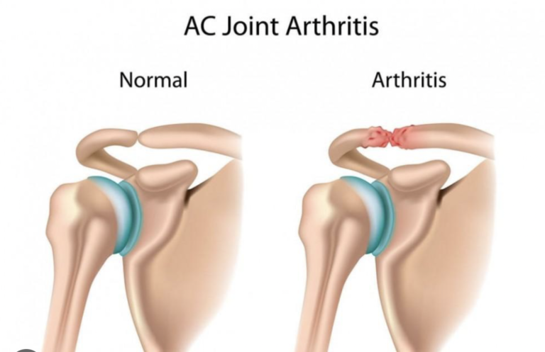 best acromioclavicular joint doctor in Udaipur
