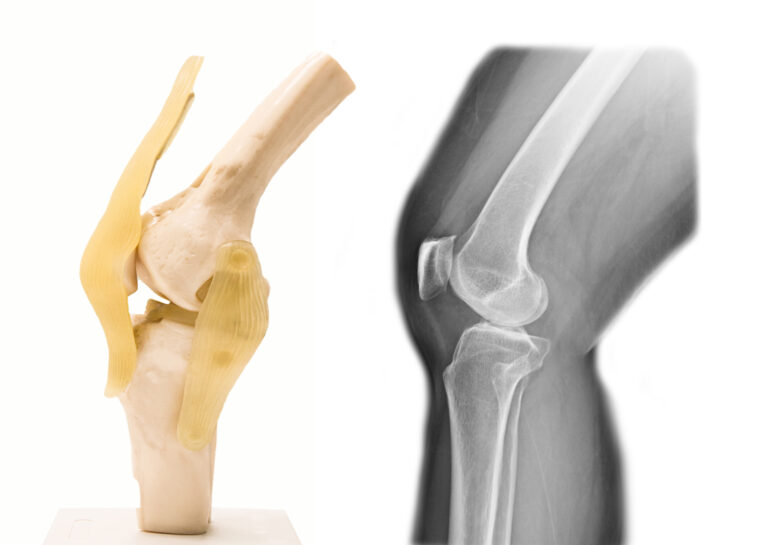 Best ACL Reconstruction Doctor in Udaipur